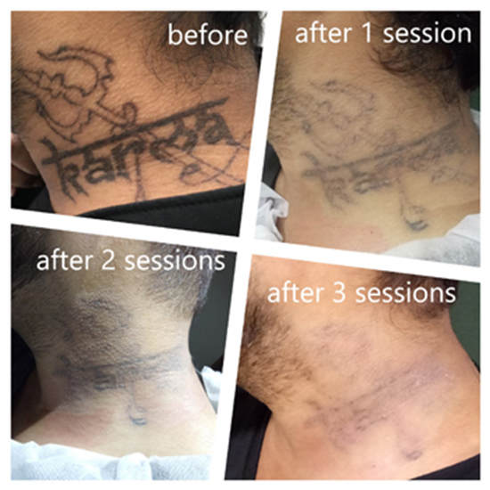 Before / After Images of Laser Tattoo Removal treatment | Orchid Cosmo laser
