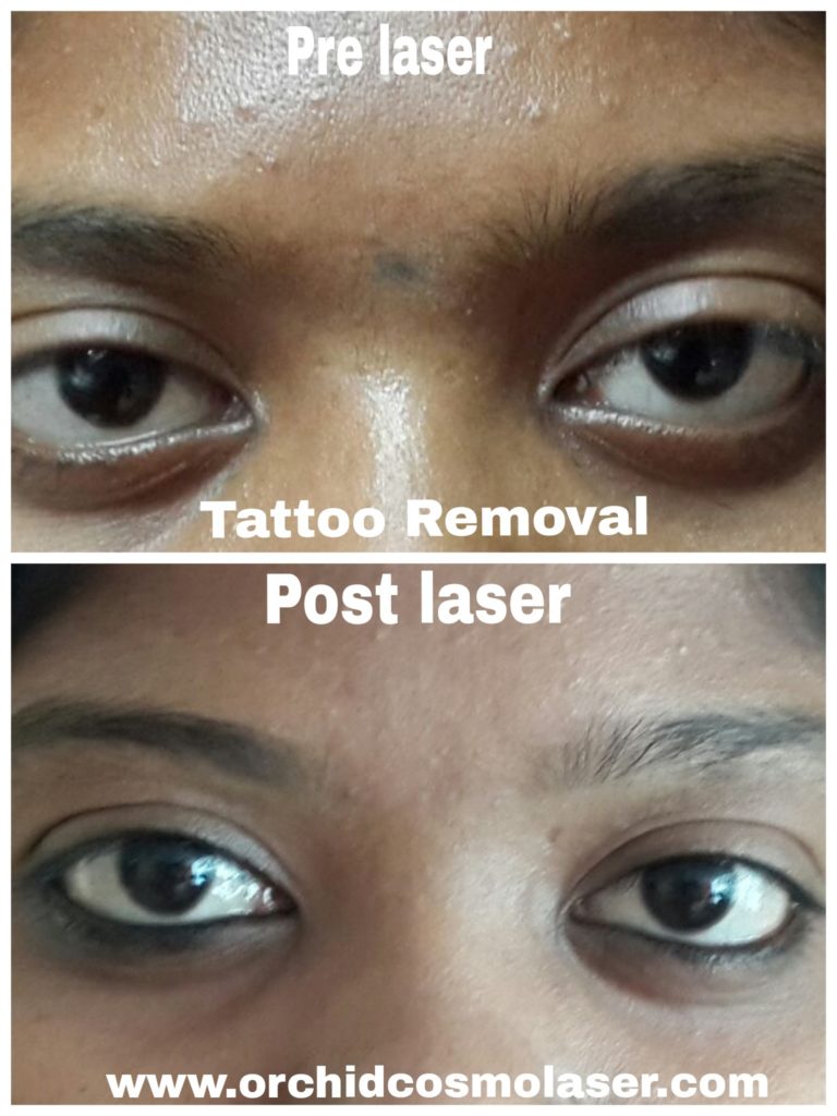 Before After Images Of Laser Tattoo Removal Treatment Orchid Cosmo